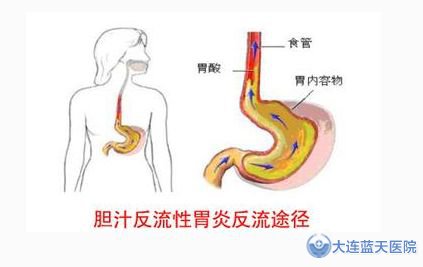 反流性胃炎治疗时有哪些误区