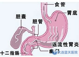 胆汁反流性胃炎有哪些症状