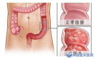 慢性肠炎传统检查项目